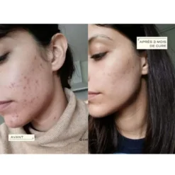 Circles Cure détox & acné hormonale CLEAR