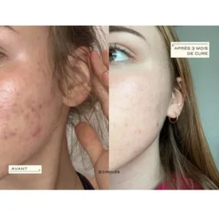 Circles Cure détox & acné hormonale CLEAR